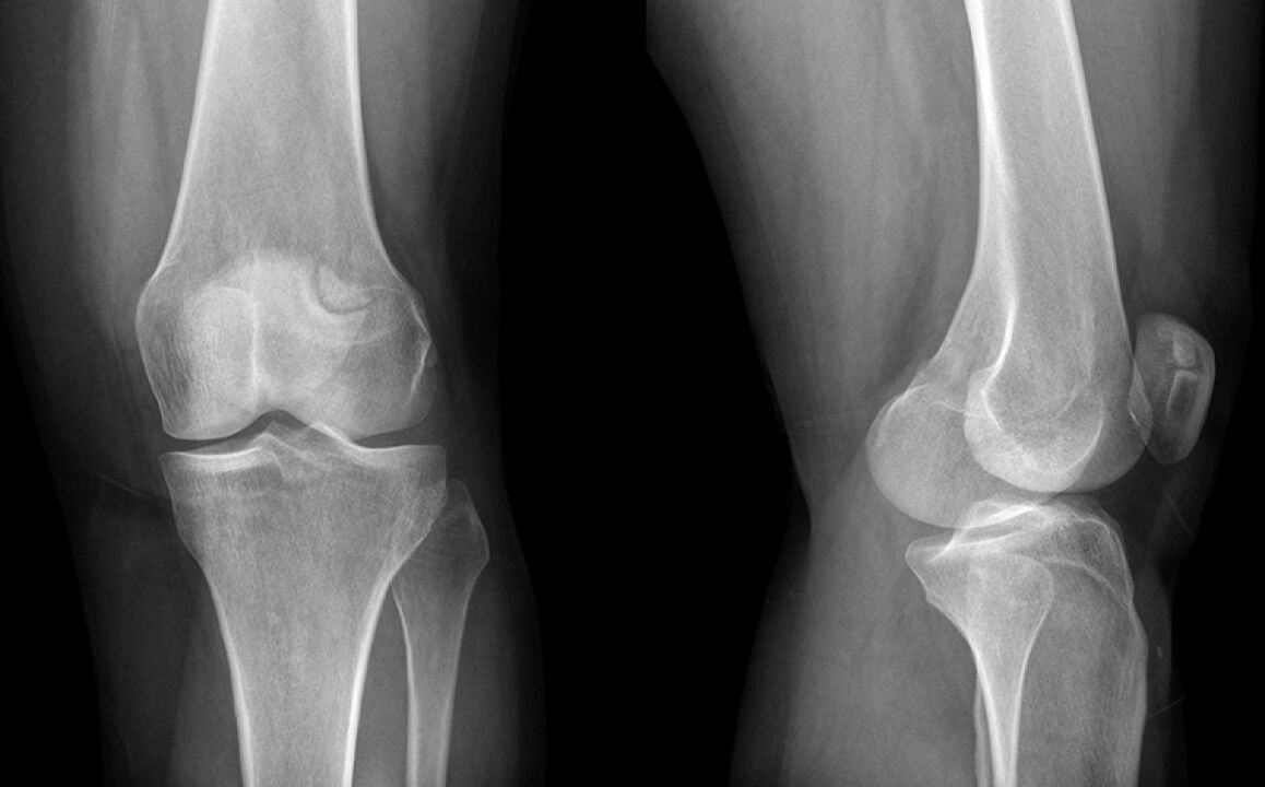 Die Arthrose des Knies auf dem X -Strahlen vor der Verwendung von Hondroine
