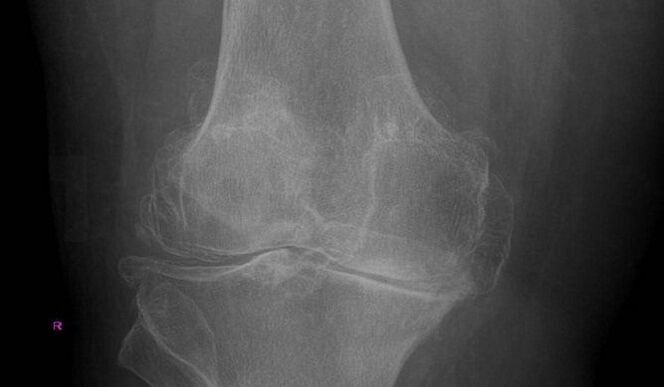 Diagnose von Arthrose