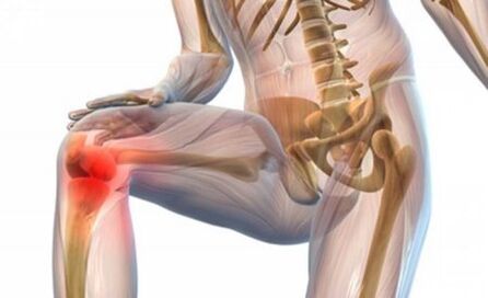 Arthrose des Kniegelenks