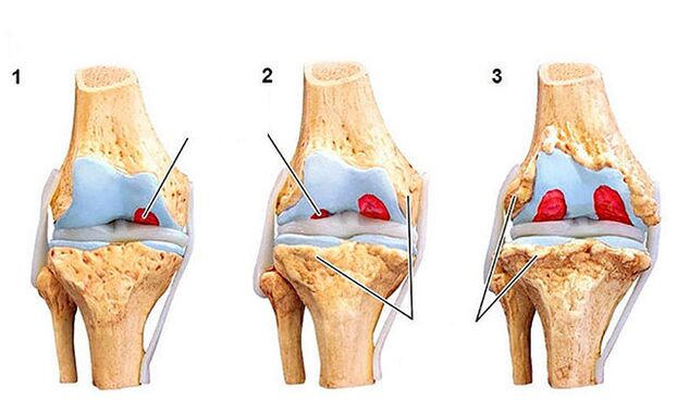 Der Entwicklungsgrad der Arthrose