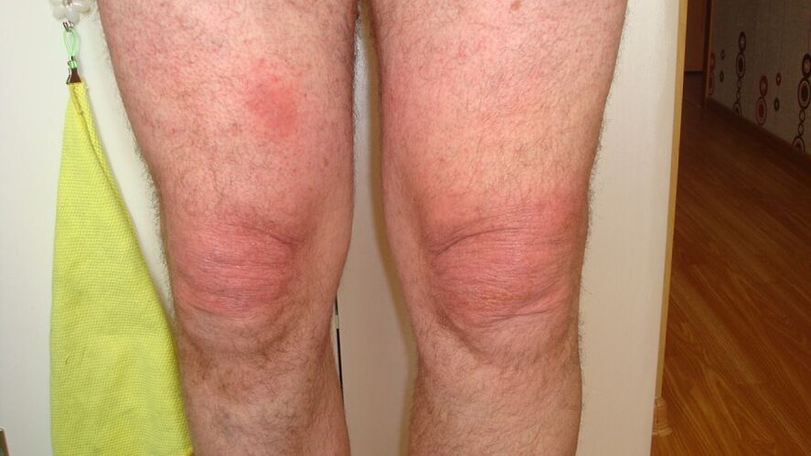 Arthrose der Kniegelenke