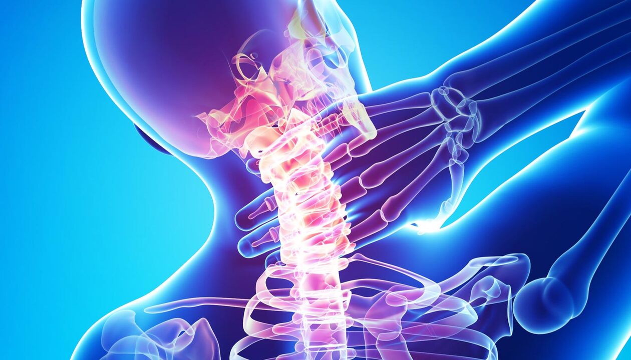 Nackenschmerzen aufgrund von Osteochondrose