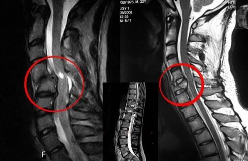 Kompression des Rückenmarks – eine Indikation für eine Operation